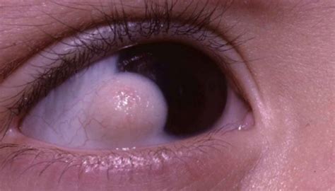 Bump On Eyeball Causes Pictures Yellowish White Clear Treatment