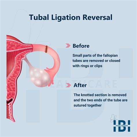 Tubal Ligation Reversal Reclaiming Fertility Journey To Parenthood