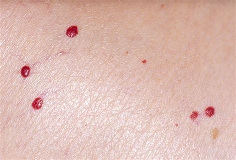 Picture Of Skin Diseases And Problems Cherry Angioma