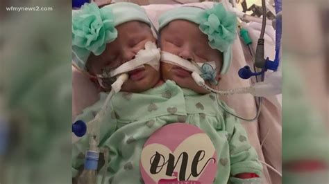 Little Angels North Carolina Conjoined Twins Pass Away Cbs19tv