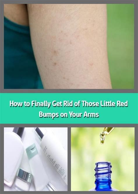 They may not cause any pain. How to Finally Get Rid of Those Little Red Bumps on Your ...