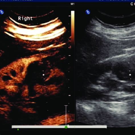 Ultrasound Images Of Complex Cystic Renal Mass Bosniak Classification