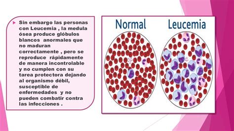 Leucemia Definicion Sintomas Fisiopatologia Diagnostico Medico D