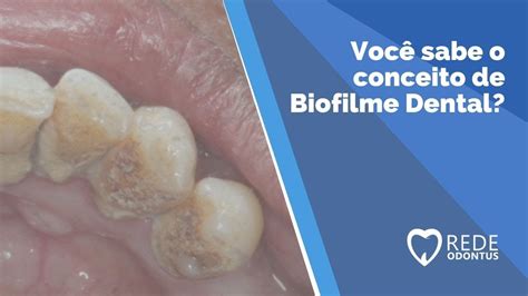 O Que é Biofilme Dental