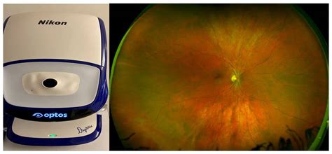 Retinal Imaging Narayana Nethralaya