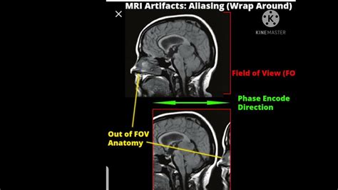 Mri Artifacts Radiology Youtube