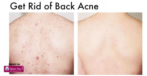 Acne Back Breakouts Whats The Deal With Acne On Your Back