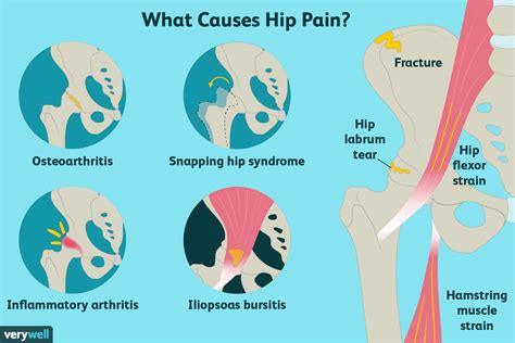 Hip Pain Might Not Be A Hip Problem Miller Orthopedic Specialists