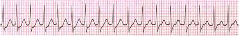 Svt is usually paroxysmal (psvt) and episodes may occur regularly or very infrequently (sometimes years apart). Psvt / Float Nurse: EKG Rhythm Strip Quiz 3 : Psvt ...