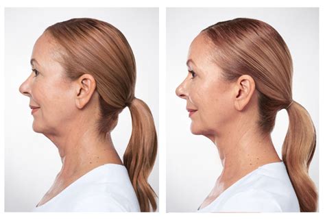 Kybella® Injections Treat Double Chin Pioneer Valley Plastic Surgery