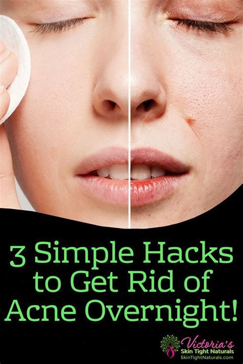 Hyaluronic acid has a variety of benefits which make it a smart choice for this exact purpose. How To Get Rid Of Acne Overnight. 3 Crazy Hacks That ...