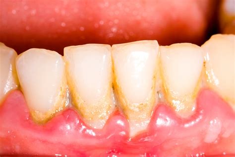 Dental Plaque Causes Symptoms And Preventive Measures Monash