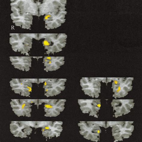 Amygdala Activation For The Individual Subjects Shown For A Glucose