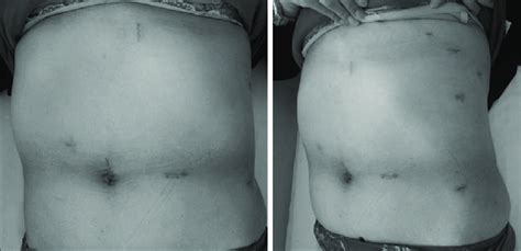 Post Operative Scars After Minimally Invasive Abdominal And Left