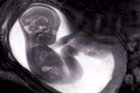 when the fetal ultrasound gained popularity in the 1970s it was hailed as a “window to the womb