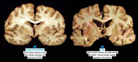 Cte Brain Compared To Normal Brain Mri Of Truamatic Brain Injury By