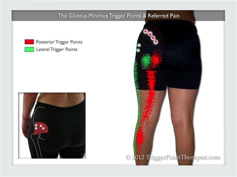 Place a pillow between their knees and shins when lying on the unaffected side to limit adduction of the affected hip 6. Gluteus Minimus Trigger Points: Small Muscle...Big Mouth | TriggerPointTherapist.com