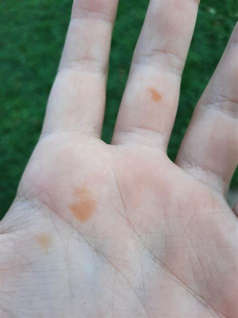 Why Do I Have Yellow Spots On My Hand They Arent Blisters And Feel