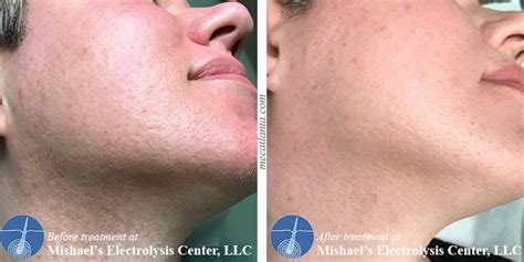 Before And After Electrolysis Hair Removal Mishaels Electrolysis Center