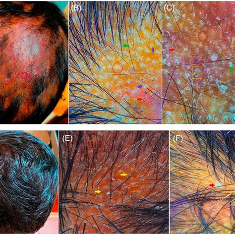 Histopathology Shows Psoriasiform Spongiotic Hyperplasia With