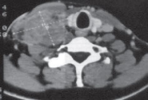 Two Computed Tomography Scans Showing Left Supraclavicular Tumor