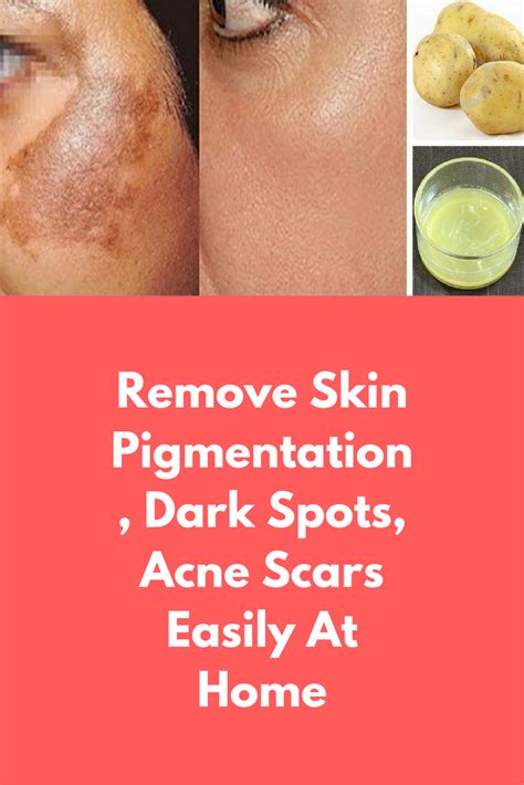 4 Home Remedies To Remove Skin Pigmentation Justinboey