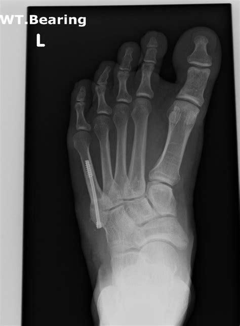 Fifth Metatarsal Fracture Surgery Metatarsal Fracture 44944 Hot Sex Picture