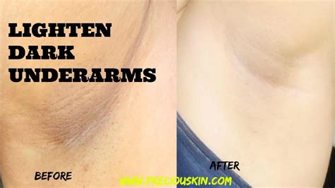 How to get rid of dark underarms permanently | style novi. How to LIGHTEN DARK UNDERARMS WITHIN 10 MINS | BAKING SODA ...