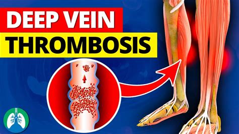 Deep Vein Thrombosis Dvt Quick Medical Overview Youtube