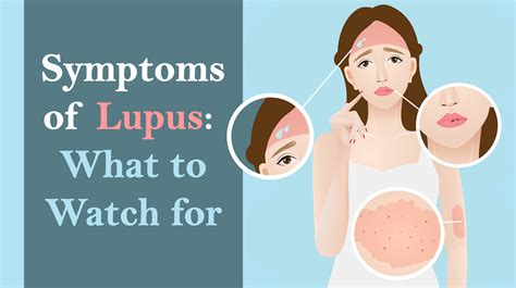 10 Silent Symptoms Of Lupus To Watch For Womenworking