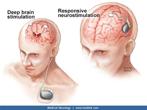 Brain Stimulation For Epilepsy Medlink Neurology
