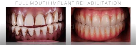Titanium Tooth Dental News Network