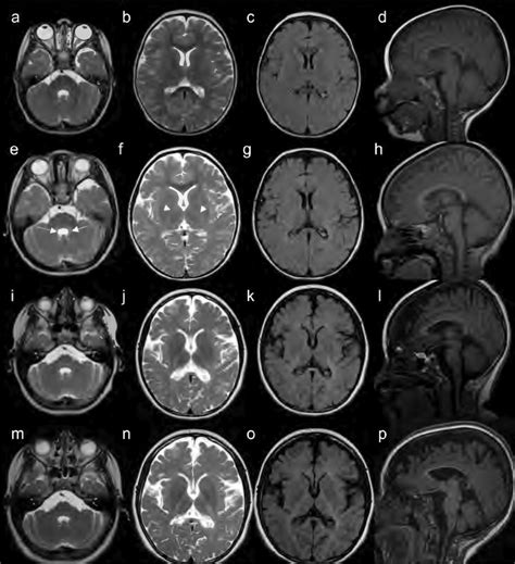 Serial Brain Mris Of Patient 5 Ad Mri At Age 2 Years Shows Mild