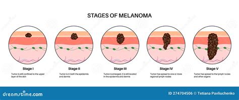 Melanoma Stages Poster Stock Vector Illustration Of Body 274704506
