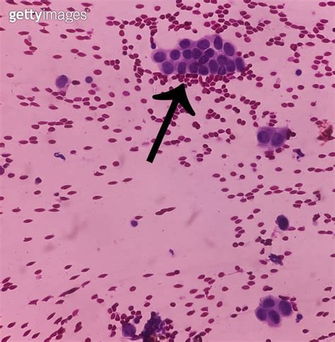 Axillary Lymph Nodefna Cytology Positive Malignant Cell Metastatic