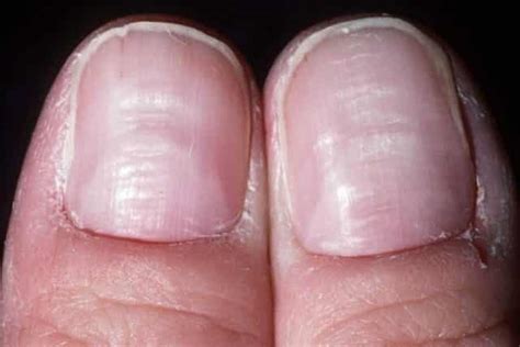 Most commonly, dark stripes down a person's nail are due to a symptom known as linear why do some toenails have horizontal ridges? Ridges in Fingernails, Beau's, Lines, Horizontal, Vertical ...