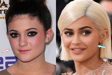 Kylie Jenner Before and after: Nose Job, Lip Injections ...
