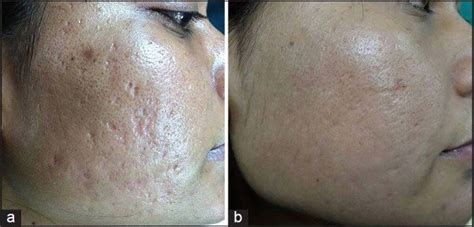 A Grade 3 Acne Scars B Improvement In Acne Scars From Grade 3 To