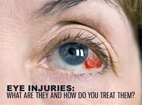 Eye Injuries What Are They And How Do You Treat Them