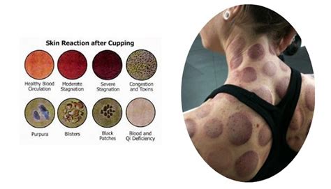 Cupping Healing Touch Bodyworks