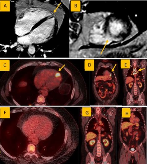 Cardiac Sarcoidosis The Role Of Cardiac Mri And 18f Fdg Petct In The
