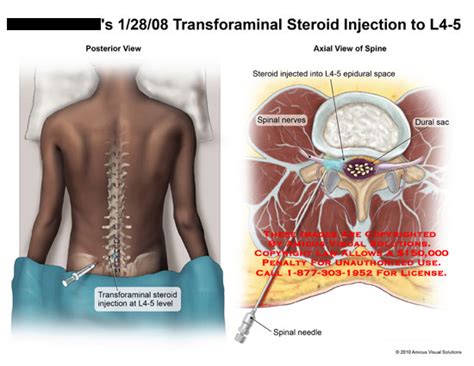 Amicus Illustration Of Amicus Surgery Injection Transforaminal Steroid