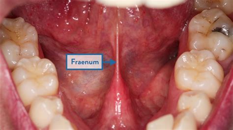 White Spot On Floor Of Mouth Under Tongue
