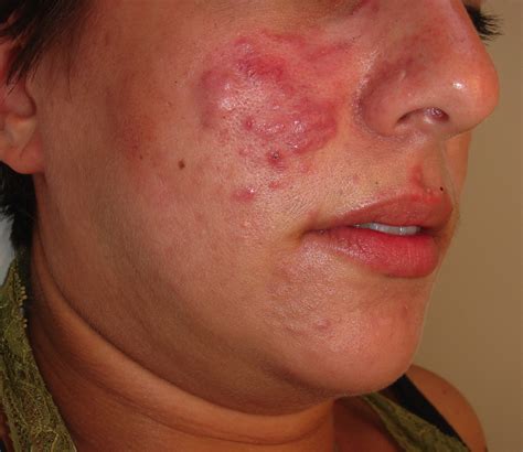 A Red Plaque On The Cheek