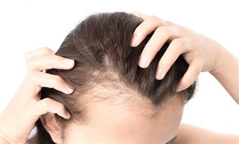 Les differentes causes de perte de cheveux Alopécie Calvitie