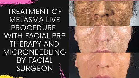 Treatment Of Melasma Live Procedure With Facial Prp Therapy And