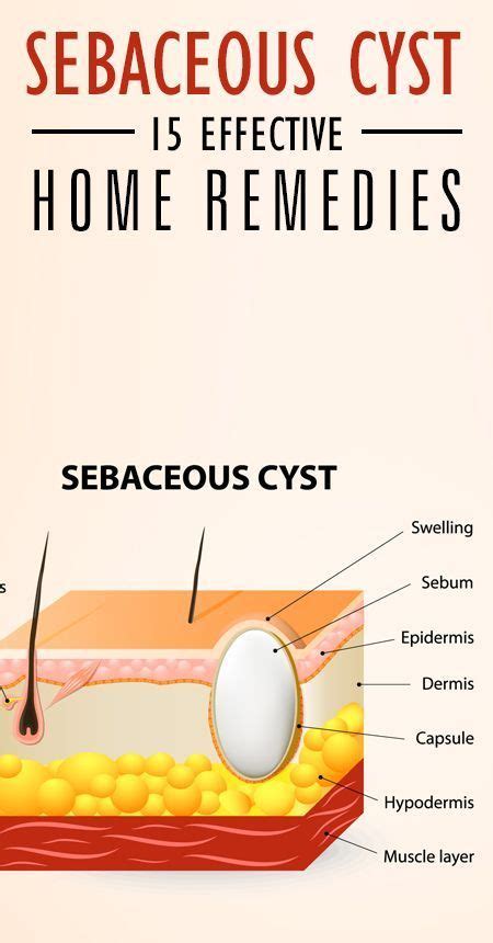 14 Home Remedies To Treat Sebaceous Cysts Health Remedies Health