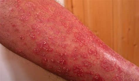 Malattie della pelle sempre più diffuse al quarto posto tra tutte le