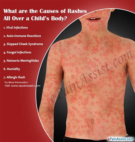 Causes Of Rashes All Over A Childs Body And What Can You Do