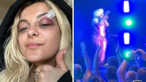 singer bebe rexha shares pic of cut on eye after fan throws phone at